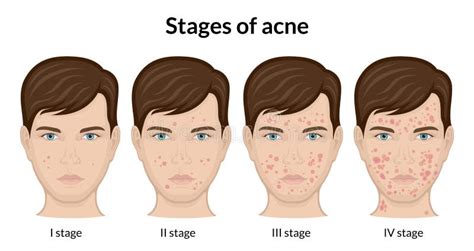 Stages Of Acne Stock Vector Illustration Of Acne Phase 254762469