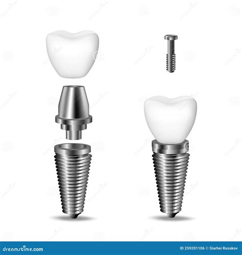 Conjunto Vectorial Realista 3d De Implantes Dentales Elementos