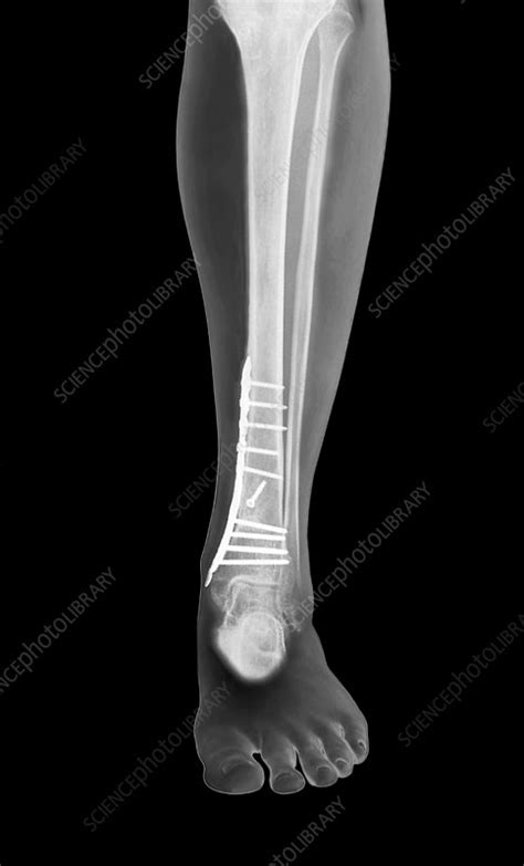 Pinned And Plated Broken Leg X Ray Stock Image C0302140 Science