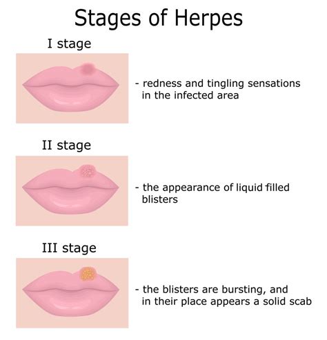 Living With Herpes Causes Symptoms How To Deal With Herpes