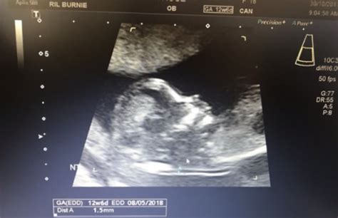 Anterior Placenta Ultrasound Babycenter