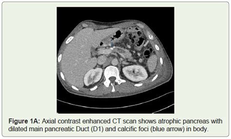 Imaging Features Of Pancreaticopleural Fistula A Frequently Missed