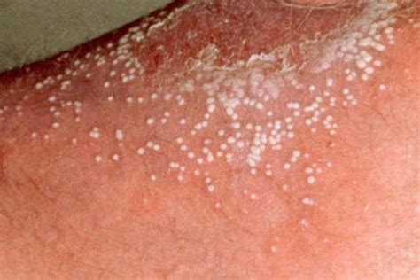 How To Cure Small Itchy Bumps On Skin