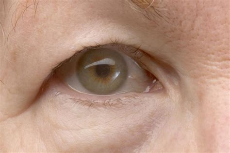 Droopy Eyelid Ptosis Causes Risk Factors And Treatment