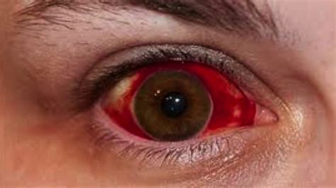 What Caused This Subconjunctival Hemorrhage Youtube