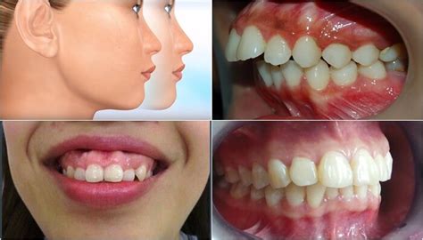 Phẫu thuật phaco loại bỏ thủy tinh thể bị đục, thay thế bằng ống kính nội nhãn (iol), khôi phục thị lực cho bệnh nhân. Phẫu Thuật Hàm Hô Không Cần Niềng Răng: An Toàn - Bền Vững