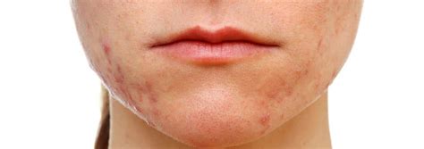 Q A Fixing Cystic Acne Scars Laseraway