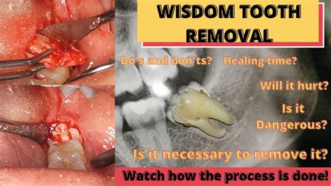 Wisdom Tooth Removal Process Surgery And All Things You Need To Know Youtube