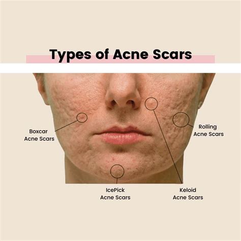 Types Of Acne Scars Albany Laser