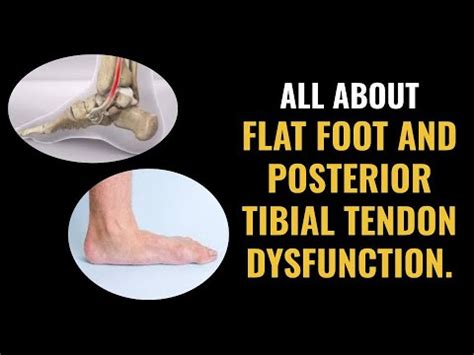 Flat Foot And Posterior Tibial Tendon Dysfunction What You Need To Know Youtube