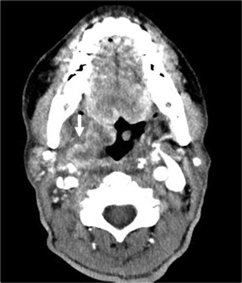 Ni Rads To Predict Residual Or Recurrent Head And Neck Squamous Cell