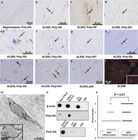 Dipeptide repeat (DPR) pathology in the skeletal muscle of ALS patients with C9ORF72 repeat 