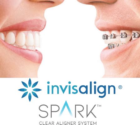 Orthodontics Invisalign Spark Aligners Mascot Dental Clinic