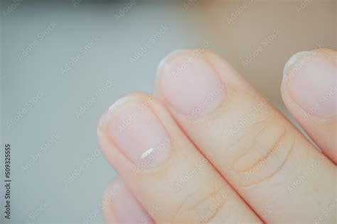 White Spots On Finger Nails Called Leukonychia Reveal The Emergence Of