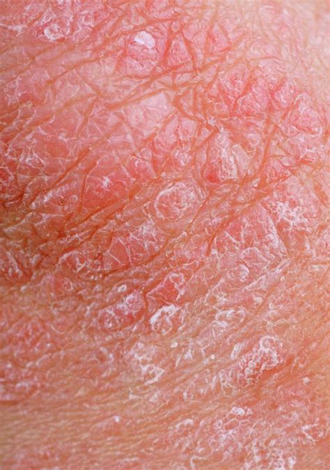 What Is The Difference Between Psoriasis And Dermatitis