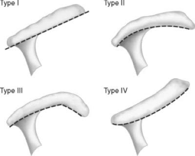 There are three distinct morphological shapes (bigliani classification) for the undersurface of the acromion: 50+ Type Ii Acromion - できる