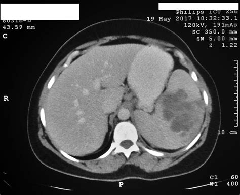 Fever Of Unknown Origin Due To Primary Tubercular Splenic Abscess In A