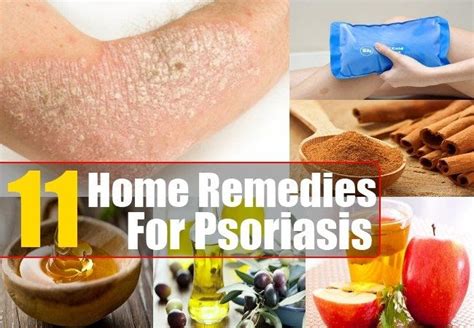 Home Remedies For Psoriasis Natural Treatments And Cure For Psoriasis