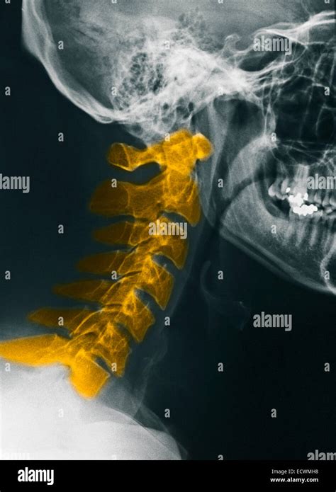 Normal Cervical Spine X Rays Stock Photo Alamy
