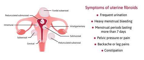 Fibroids Symptoms Complications And Treatment Medic Drive