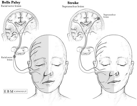 Facial Nerve Palsy Diagram