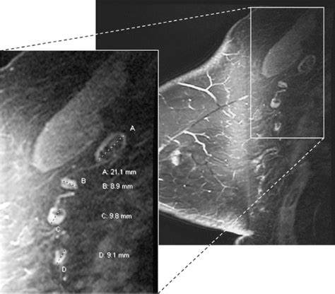 Variable Axillary Lymph Node Size And Morphology On Breast Mri 65 Yo
