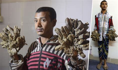Tree Man With Rare Disease Has Roots Growing From Hands