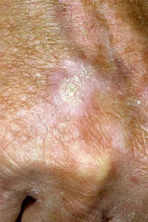 Skin Cancer Symptoms Other Than Moles Skin Cancer Symptom Melanoma