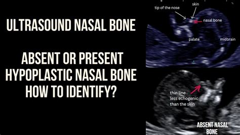 Ultrasound Pregnancy Nasal Bone Absent Present Or Short Nasal Bone
