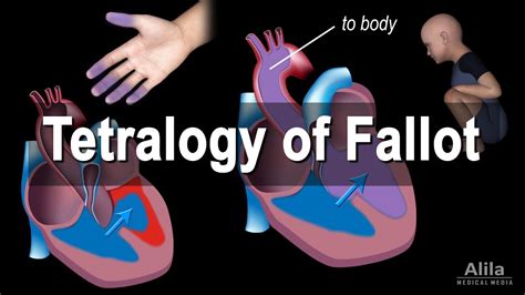 Congenital Heart Disease Tetralogy Of Fallot Animation Notadevs