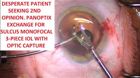 Desperate Patient Nd Opinion Panoptix Exchange Sulcus Monofocal Piece Iol With Optic