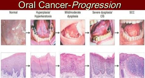 Oral Cancer Symptoms And Signs Pictures Cancerwalls