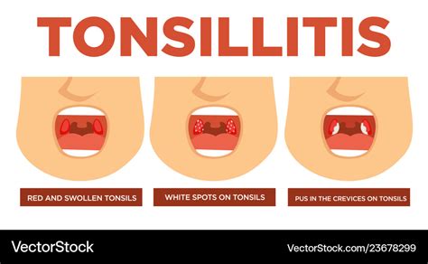 White Spots On Tonsils Not Strep
