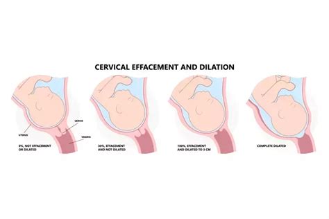 Cervix Dilation Chart Signs Stages And Procedure To Check Artofit