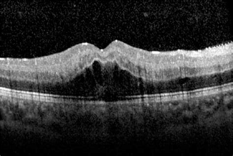 Scielo Brasil Retinal Vein And Artery Occlusion As The First