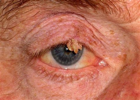 Treatment For Lump Inside Eyelid Chalazion Eyelid Cyst Mr David