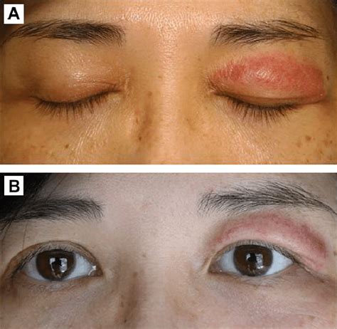 A Erythematous Swelling With Mild Scaling And Telangiectasia Of The