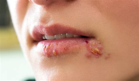 Fever Blister Vs Cold Sore Whats The Difference And What To Do