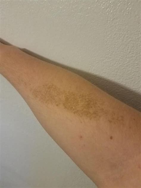 Skin Concerns What Is This Brown Patch On My Arm I Have It On Other