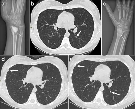 A Case Of Giant Cell Tumor Of Bone And Lung Metastases Treated With