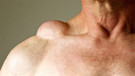 What Is A Skin Lump Symptoms Causes Diagnosis Treatment And