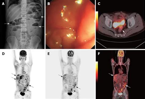 Clinical Value Of 18F FDG PET CT In Assessing Suspicious Relapse After