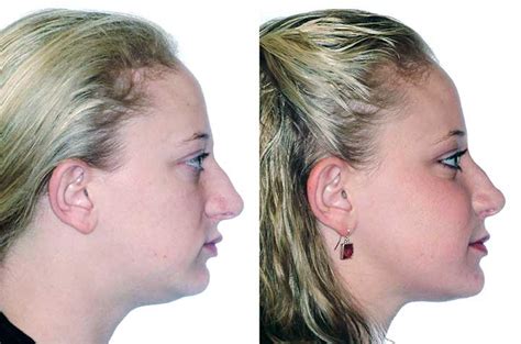 Face Airway And Bite Correction Surgery Solution Corrective Jaw