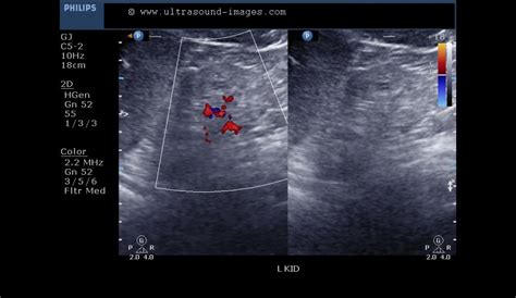 Acute Renal Failure Ultrasound