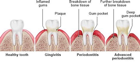 Gingivitis And Periodontitis