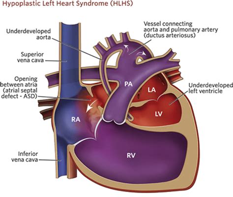Outcomes In Hypoplastic Left Heart Syndrome Pediatric Clinics