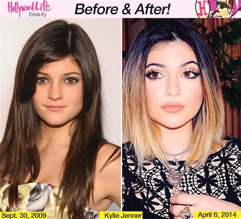 Kylie Jenner To Plastic Surgery — ‘its Insulting To Say She Got Nose