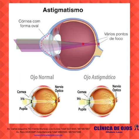 Clínica de Ojos Oftalmic Láser Astigmatismo