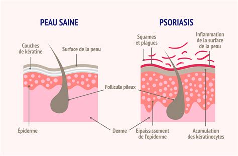 Le Psoriasis De A à Z