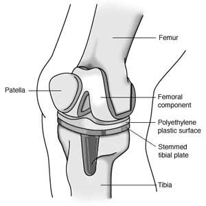 Musculo-Skeletal Nursing: Knee Replacement Pictures